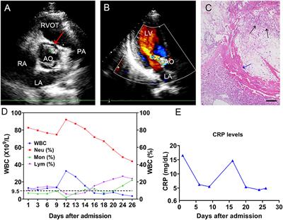 Case report: Infective endocarditis caused by Streptococcus sinensis: The first case in mainland China and literature review